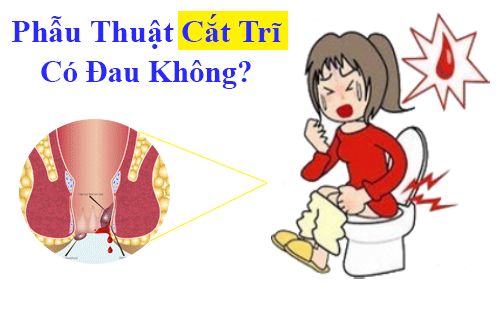 {Giải Đáp Thắc Mắc} – Phẫu Thuật Cắt Trĩ Và Chi Phí Thực Hiện
