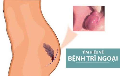 Bác Sĩ Chuyên Khoa Giải Đáp Thắc Mắc Về Bệnh Trĩ Ngoại