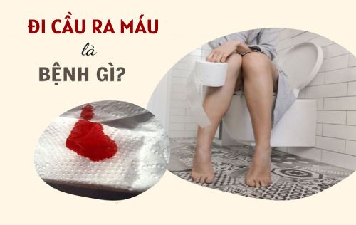 Đi Cầu Ra Máu: Tưởng Không Nguy Mà Nguy Không Tưởng